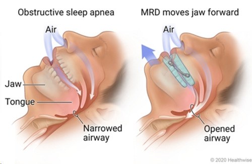 woman holding oral appliance