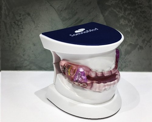 clear oral appliance